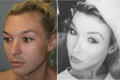 06_jaw_reduction
