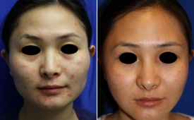 jaw-reduction-p10-1