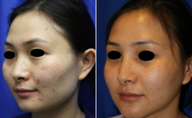 jaw-reduction-p10-2