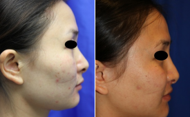 jaw-reduction-p10-3
