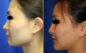 jaw-reduction-p10-4