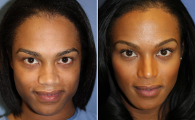 jaw-reduction-p11-1