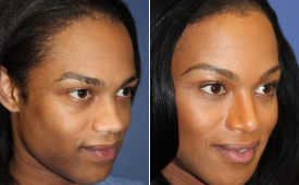jaw-reduction-p11-2