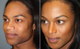 jaw-reduction-p11-3