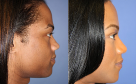 jaw-reduction-p11-4