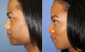 jaw-reduction-p11-5