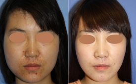 jaw-reduction-p12-1