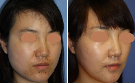 jaw-reduction-p12-2