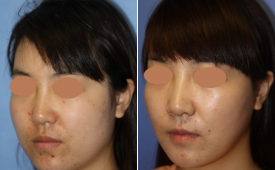 jaw-reduction-p12-3