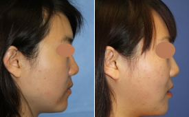 jaw-reduction-p12-4