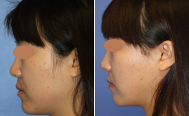 jaw-reduction-p12-5