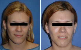 jaw-reduction-p2-1