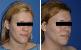 jaw-reduction-p2-2