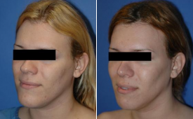 jaw-reduction-p2-3