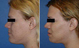 jaw-reduction-p2-4