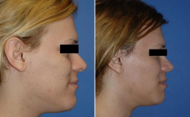 jaw-reduction-p2-5