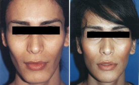 jaw-reduction-p3-1