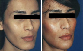 jaw-reduction-p3-2