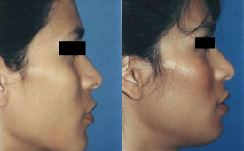 jaw-reduction-p3-3
