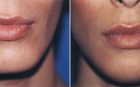 jaw-reduction-p3-4
