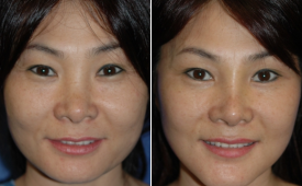 jaw-reduction-p4-1