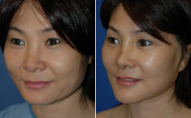 jaw-reduction-p4-2