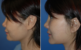 jaw-reduction-p4-3
