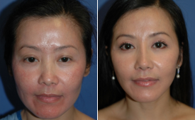 jaw-reduction-p5-1
