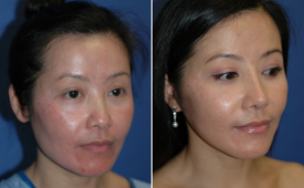 jaw-reduction-p5-2