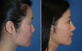 jaw-reduction-p5-3