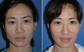jaw-reduction-p6-1