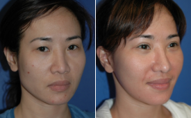 jaw-reduction-p6-2