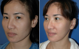 jaw-reduction-p6-3