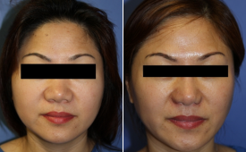 jaw-reduction-p7-1