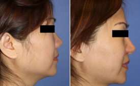 jaw-reduction-p7-3