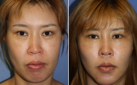jaw-reduction-p8-1