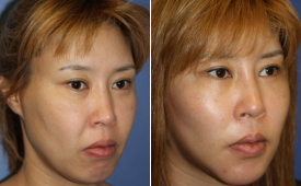 jaw-reduction-p8-2