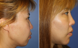 jaw-reduction-p8-3