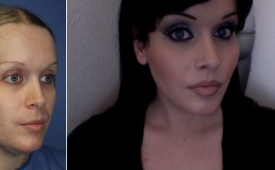 jaw-reduction-p9-2