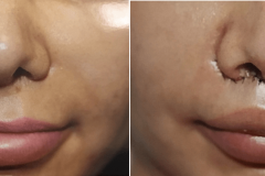 01_subnasal_lip_lift
