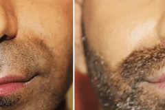 02_subnasal_lip_lift