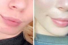 03_subnasal_lip_lift