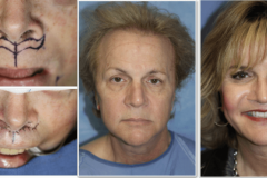 04_subnasal_lip_lift
