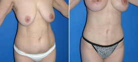 liposuction-p1-2