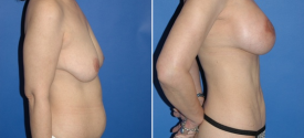 liposuction-p1-4