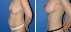 liposuction-p1-5