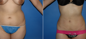 liposuction-p10-1