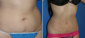 liposuction-p10-2