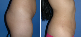 liposuction-p10-3