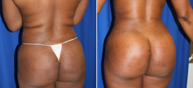 liposuction-p11-1